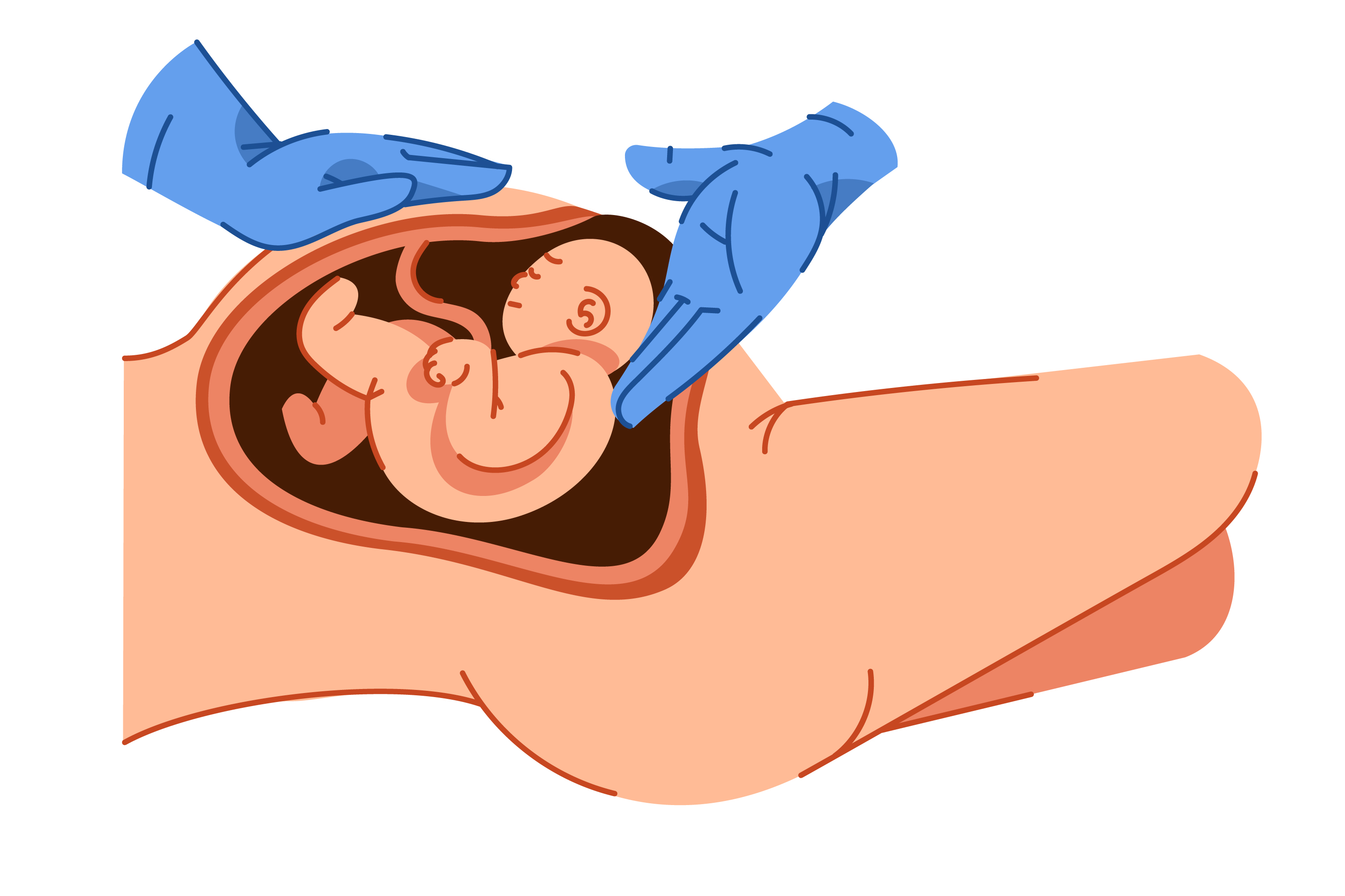 Tissue in Postpartum Haemorrhage, When the Placenta Remains Behind